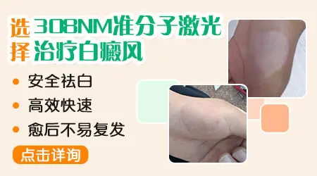 白癜风照光一次多少时间