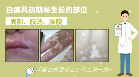 白癜风的初期症状是什么 石家庄白斑