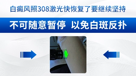 308激光能治好白斑吗