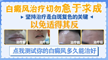 男性白癜风能喝酒吗