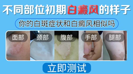 白癜风是什么样子的