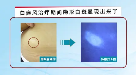 怎么判断隐形白癜风
