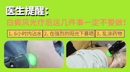 进口的308激光治疗白斑费用贵不贵