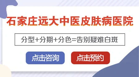 打新冠疫苗后得白癜风的治疗思路