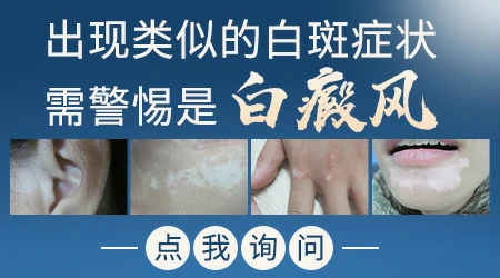 乳房皮肤白斑