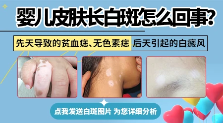 婴儿腿上有白色斑块怎么回事