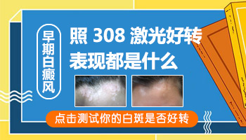 网上买的308激光治疗白癜风好用吗